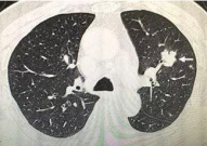 女子查出肺结节不重视成肺癌晚期,警惕肺癌晚期风险，重视体检结果”