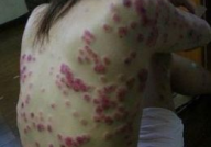 红斑狼疮图片,红斑狼疮早期症状与图片解析